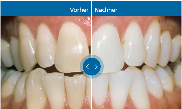 In-Office Bleaching